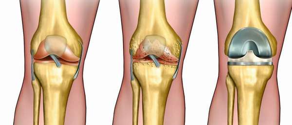 Коксартроз сустава колена